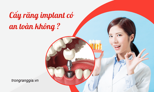 Cấy răng implant có an toàn không ?