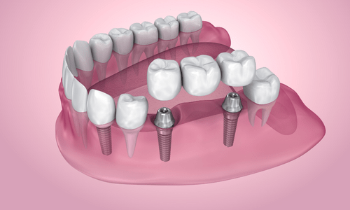 Cấy răng implant có an toàn không ?