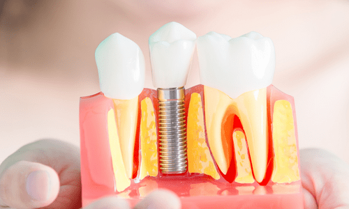 Tìm hiểu về các phương pháp trồng răng giả
