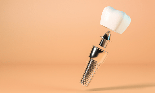 Yếu Tố Ảnh Hưởng Đến Chi Phí Trồng Răng Implant