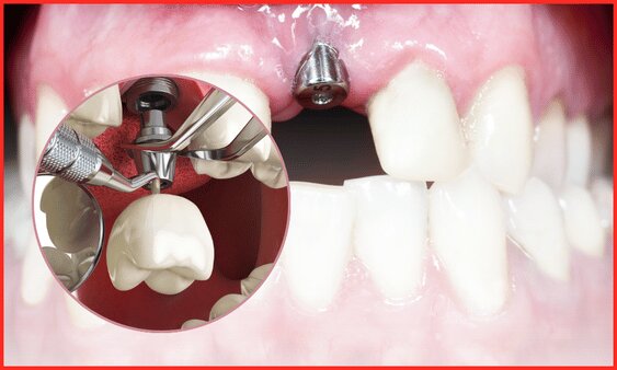 Trồng răng Implant bao lâu thì lành thương hoàn toàn?