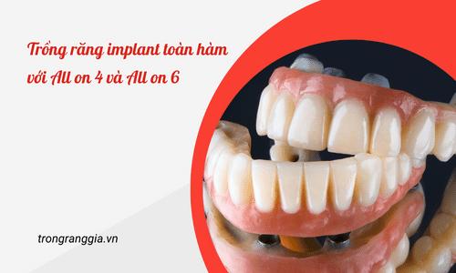 Trồng răng implant toàn hàm với All on 4 và All on 6