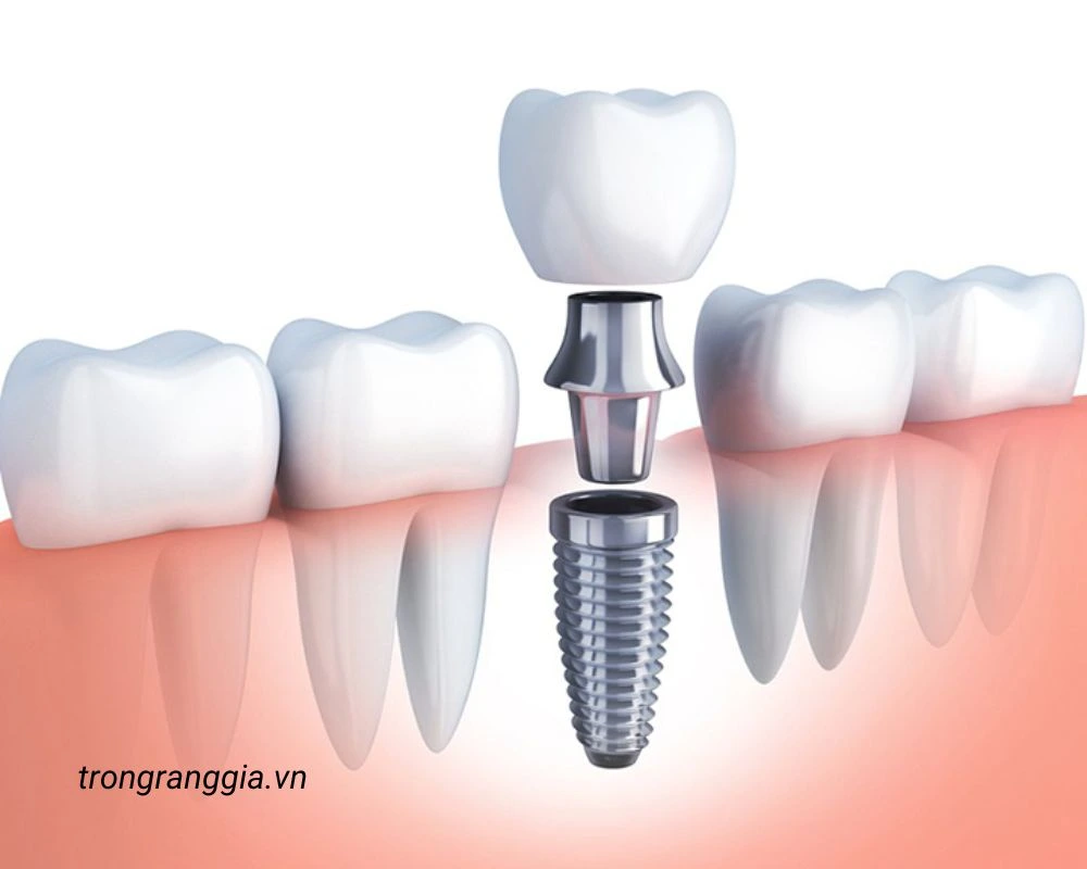 nên làm răng giả tháo lắp hay cố định