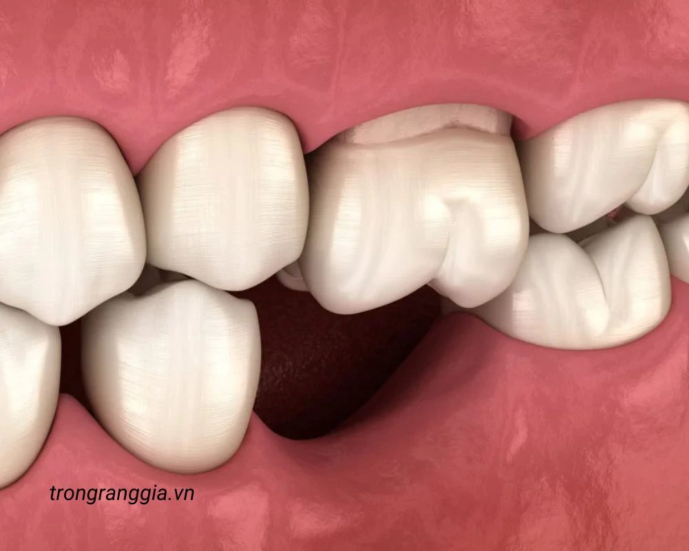 răng giả có niềng được không