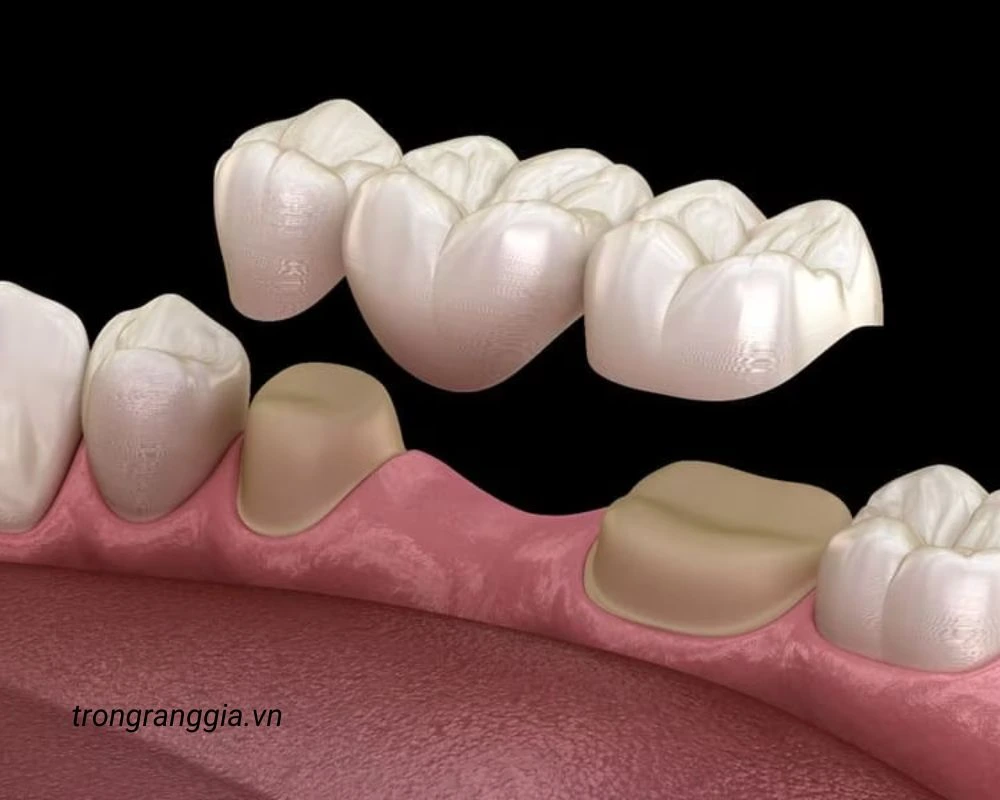 răng giả có niềng được không